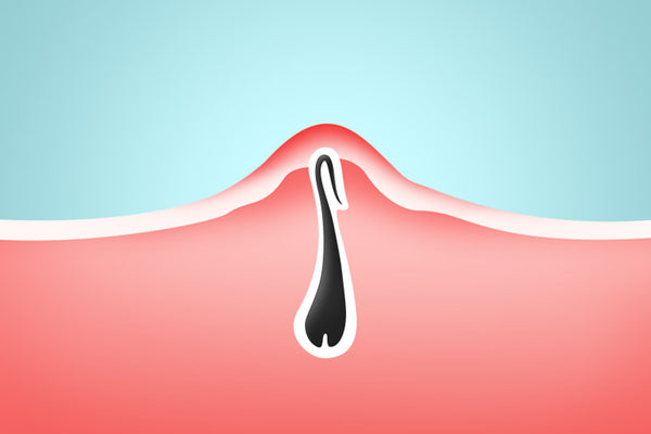 Dos and Donts For Handling Your Ingrown Hairs